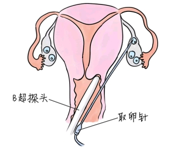 小儿退烧推拿手法 5种南昌捐卵宝宝退烧按摩方法